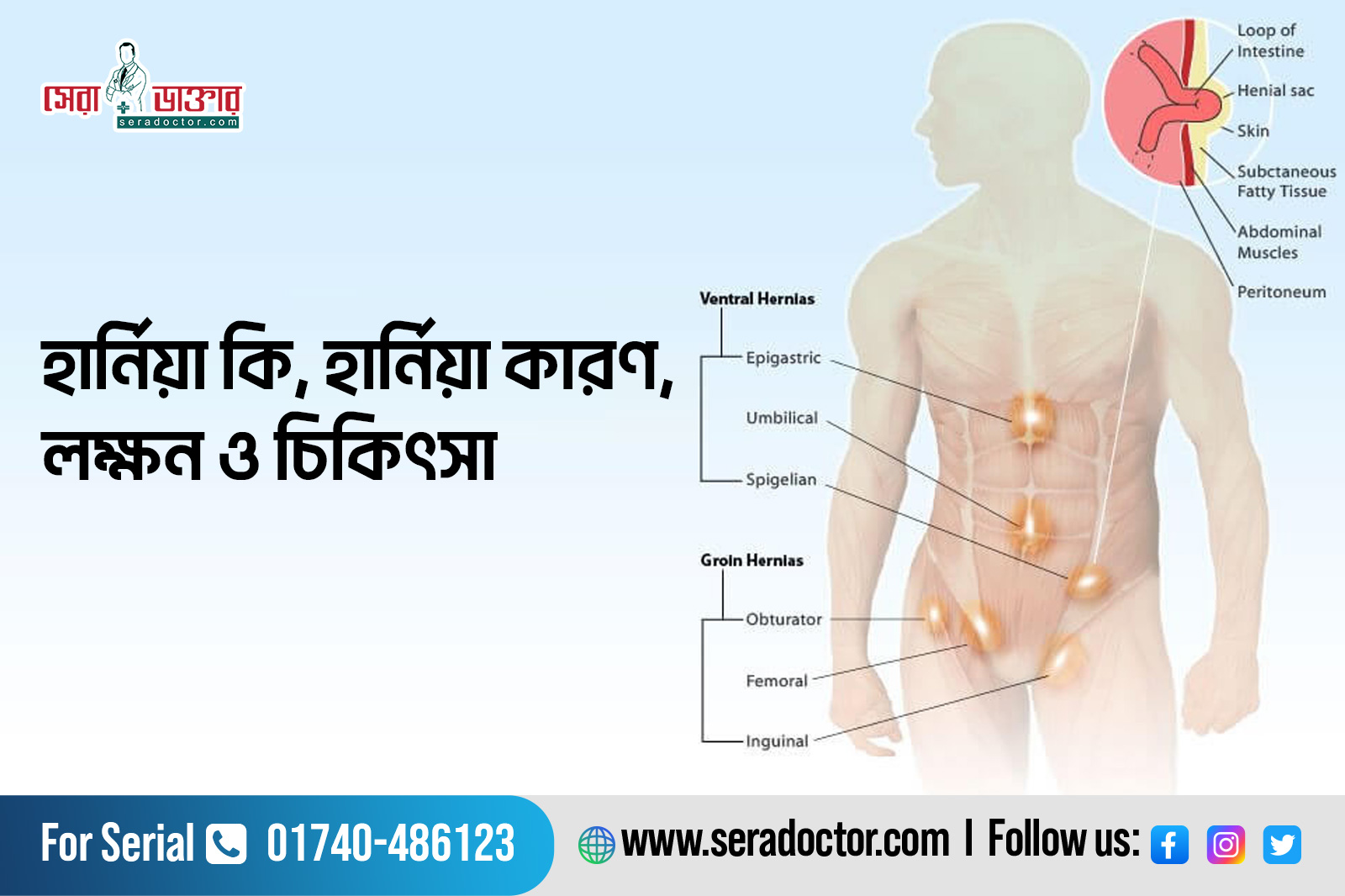 হার্নিয়া কি, কারণ, লক্ষন ও চিকিৎসা